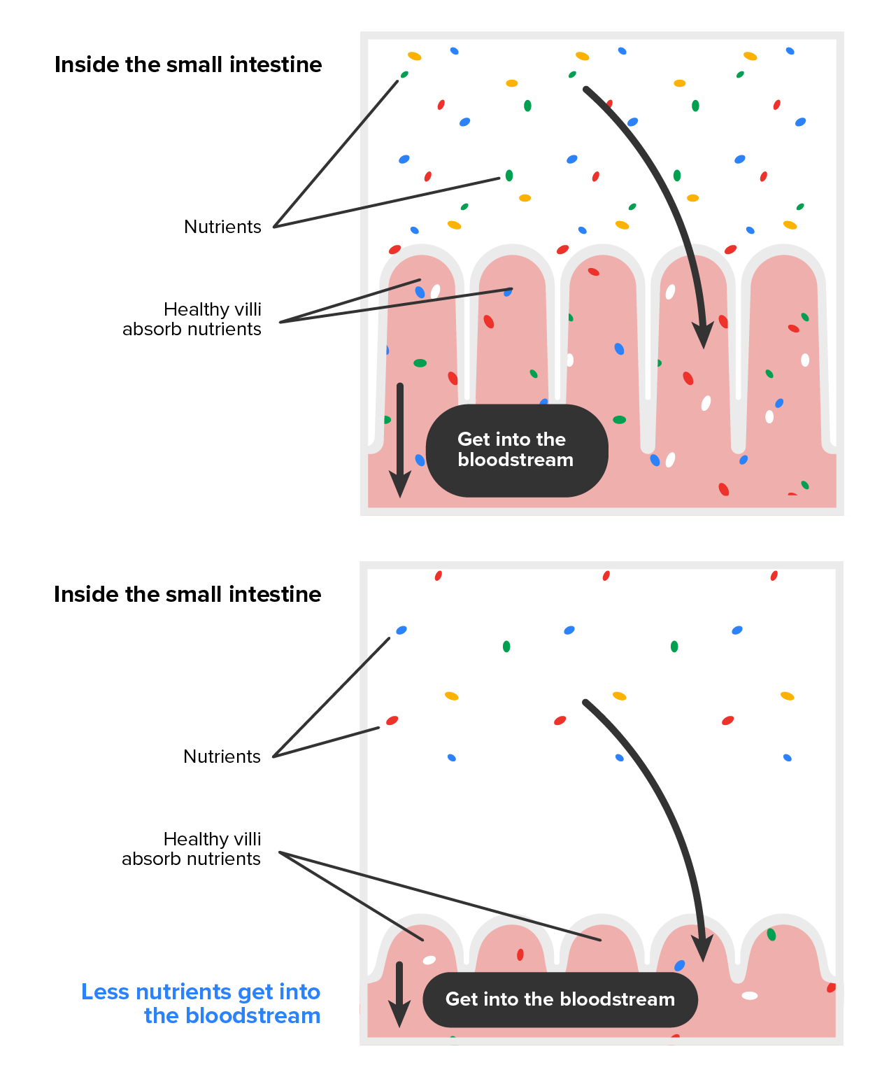 Absorption of nutrients in the small intestine. Healthy and damaged villi. Medical vector illustration