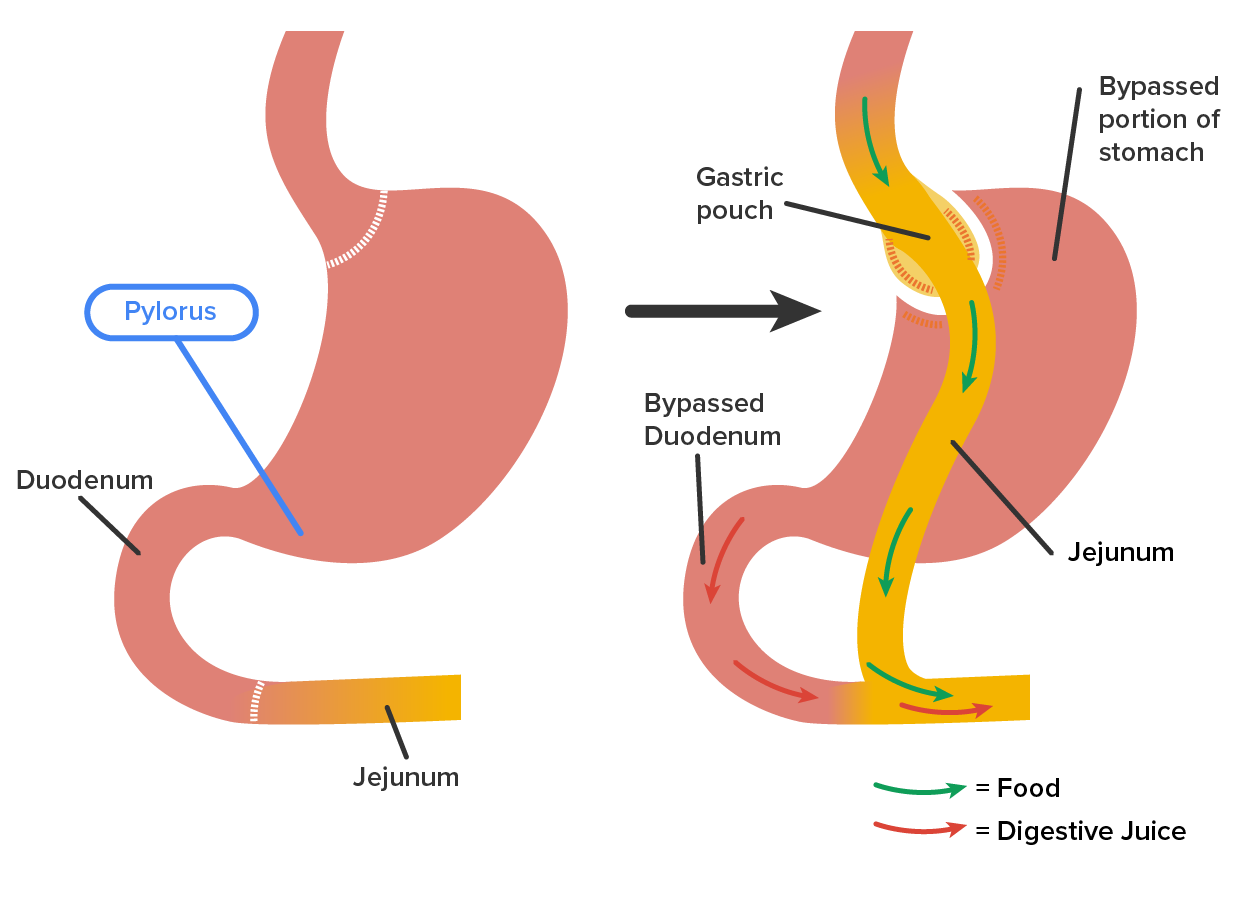 Two stomachs side by side. The stomach on the left side has e pylorus and the stomach on the right has the gastric pouch. The stomach on the left has the duodenum and the jejunum labeled. The stomach on the right has the bypassed portion of the stomach, gastric pouch, bypassed duodenum, and the jejunum labeled. The stomach on the right shows how food and digestive juice go through the stomach.