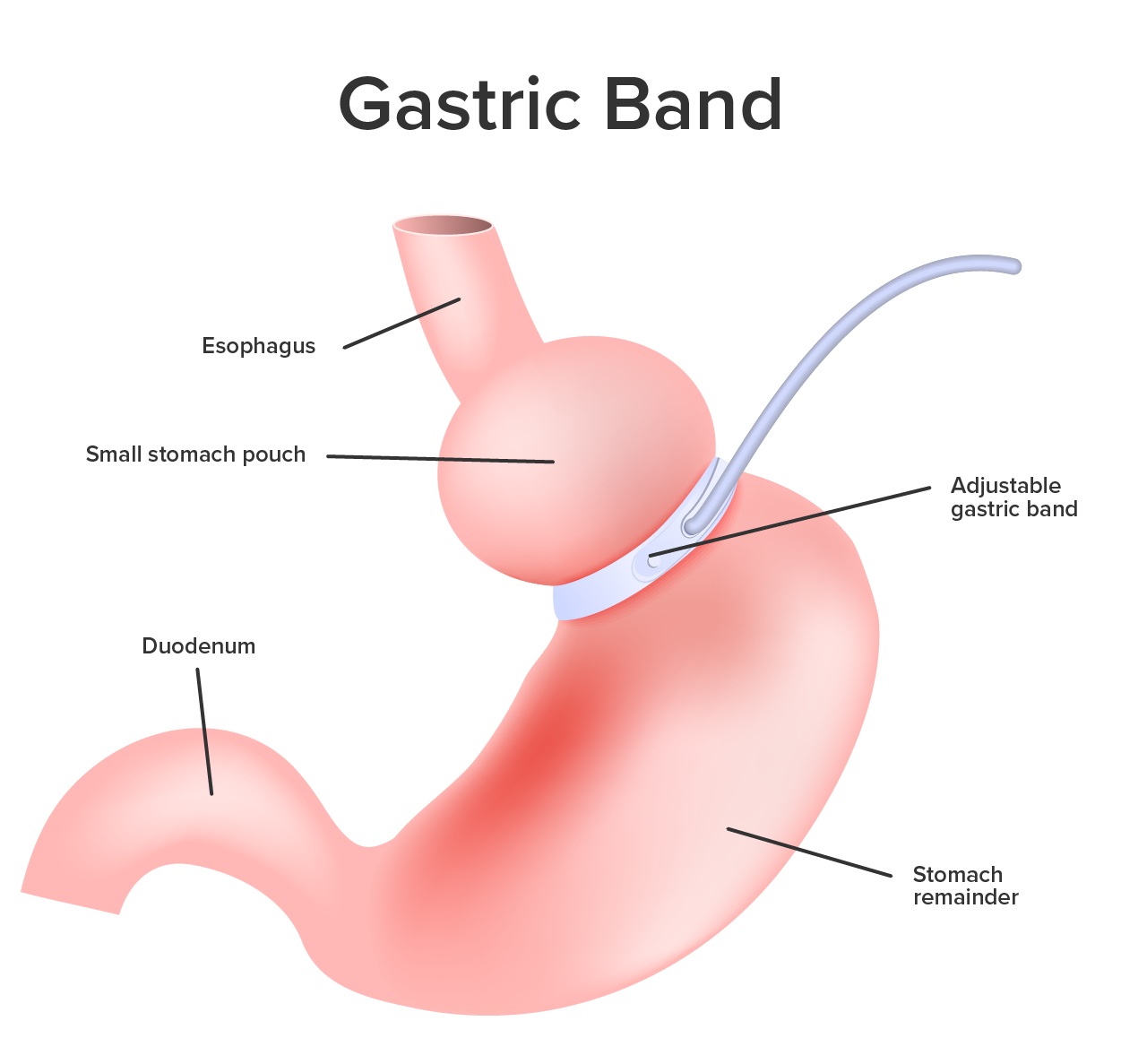 Stomach with a gastric band around it.