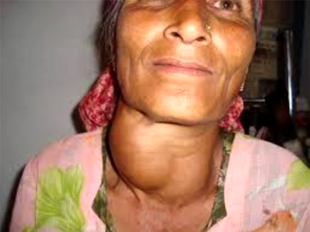Iodine Deficiency: A large goiter by Dr. J.S.Bhandari, India