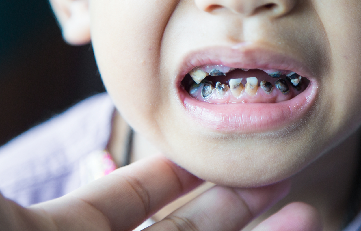 A child with early childhood caries.