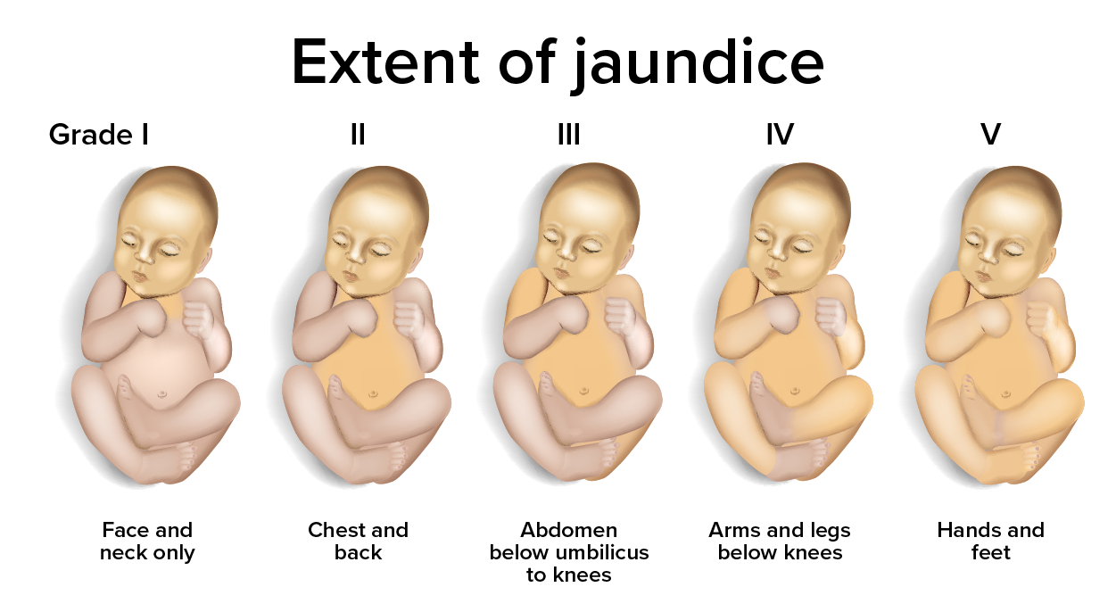 Image that shows the extent of jaundice. There are five images of babies with the different stages of jaundice. Grade 1 is on the face and neck. II is on the chest and back. III is on the abdomen below the umbilicus to the knees. IV is arms and legs below knees. V is on hands and feet.