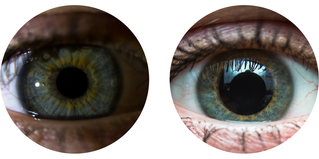 On the left, the pupils are constricted (small).  On the right, the pupils are dilated.