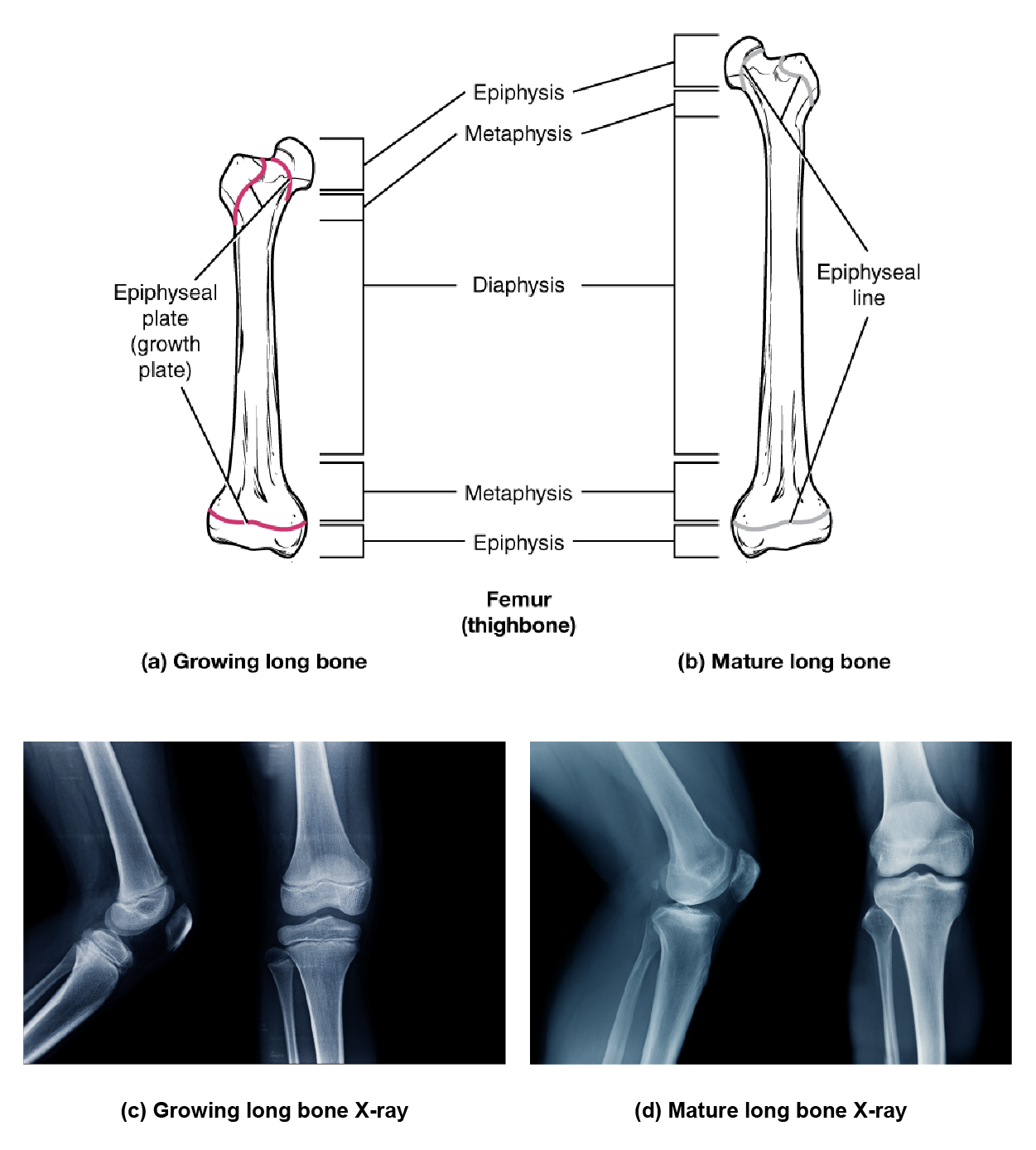 This illustration shows anterior views of a right and left femur. The left femur possesses a growth plate at the border of its distal metaphysis and distal epiphysis. The proximal epiphysis has two growth plates. The first is located below the head of the femur while the second is located below the trochanter, which is the bump on the lateral side of the femur. The right femur has the same plates as the left femur. However, the left femur represents a mature long bone. Here, growth is completed and the epiphyseal plate has degraded to a thin, faint, epiphyseal line. In the lower panel, x-ray images show a growing long bond with dark gaps where the growth plates exist and a mature bone where the same region is bright white bone.