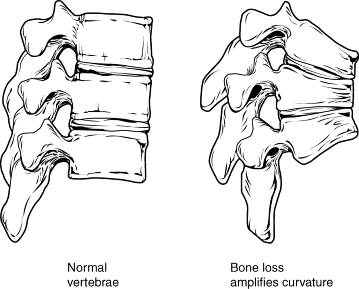 Osteoporosis - Osteoporosis is an age-related disorder that causes the gradual loss of bone density and strength. When the thoracic vertebrae are affected, there can be a gradual collapse of the vertebrae. This results in kyphosis, an excessive curvature of the thoracic region.lalt=This figure shows the changes to the spine in osteoporosis. The left panel shows the structure of normal vertebrae and the right panel shows the curved vertebrae in osteoporosis.