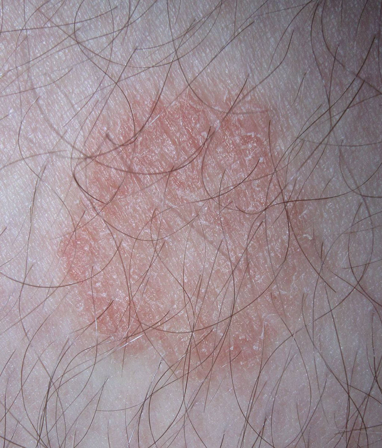 Circular Ringworm Virulence Factors of Eukaryotic Pathogens Tutorial | Sophia Learning