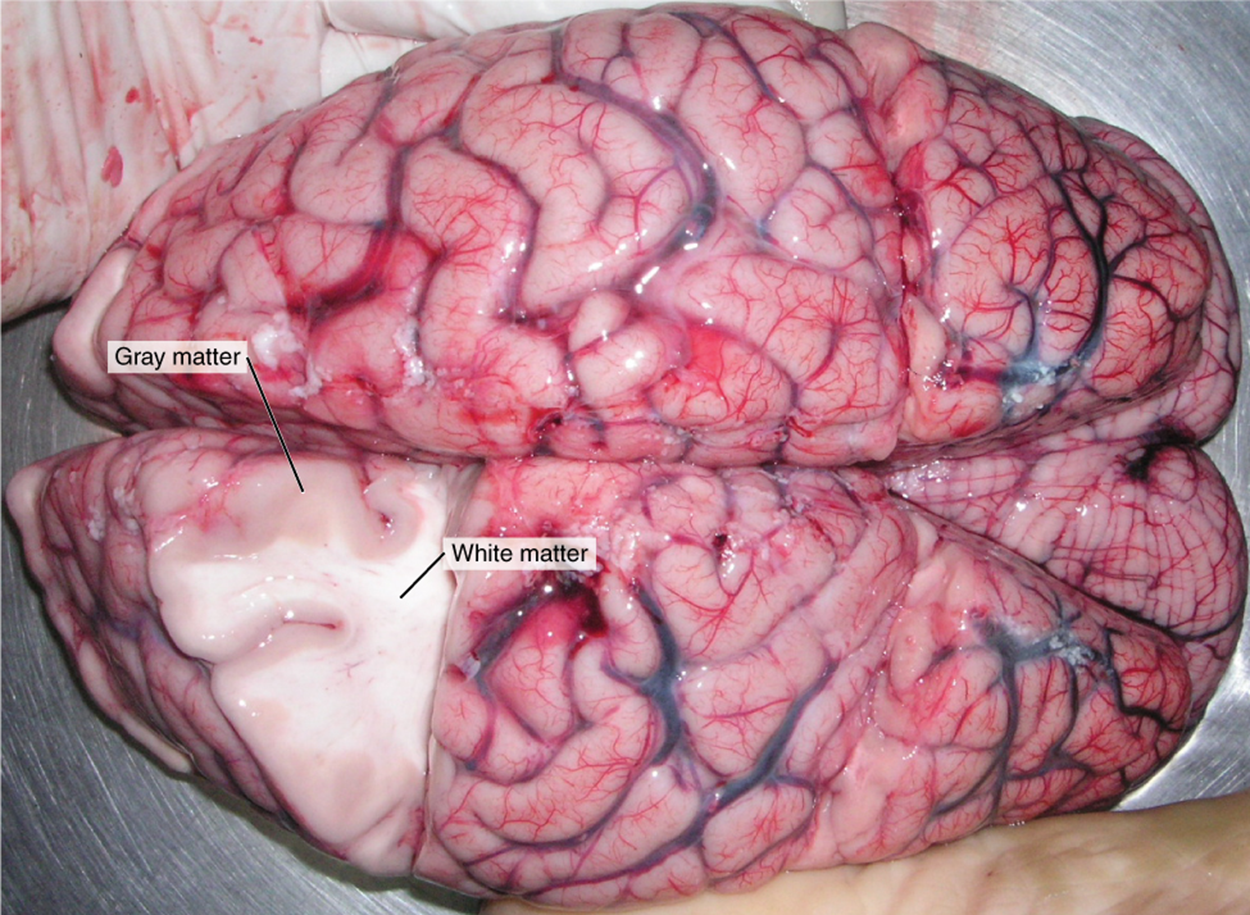 This photo shows an enlarged view of the dorsal side of a human brain. The right side of the occipital lobe has been shaved to reveal the white and gray matter beneath the surface blood vessels. The white matter branches through the shaved section like the limbs of a tree. The gray matter branches and curves on the outside of the white matter, creating a buffer between the outer edges of the occipital lobe and the internal white matter.
