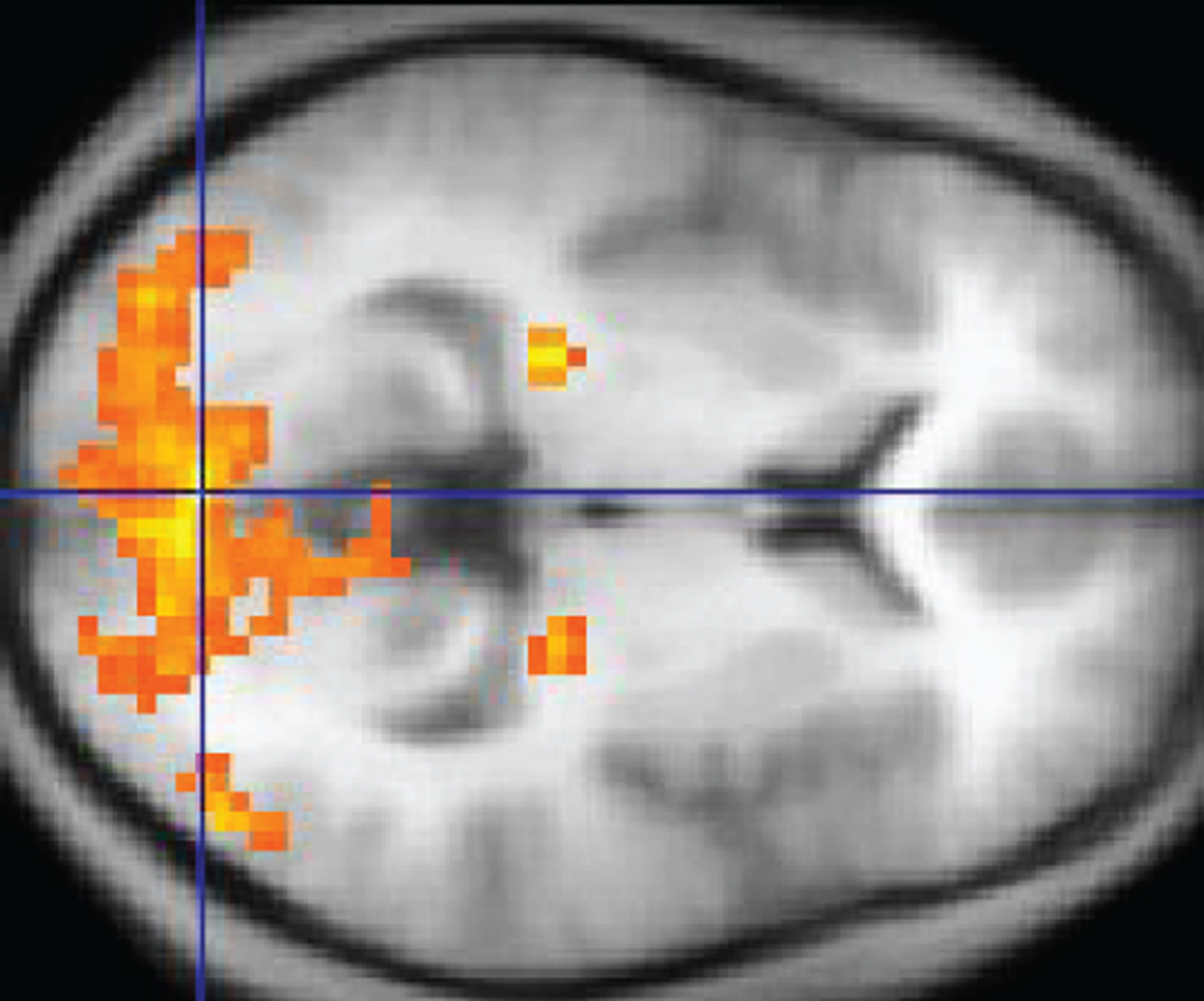 This MRI image shows a grainy computer readout of a cross-section of the brain. The anterior side of the brain, located on the right-hand side of the image, has a large area lighting up with yellow, indicating neural stimulation. Two smaller regions at the center of the brain are also yellow. The two small areas are in the same relative location but in opposite hemispheres of the brain.