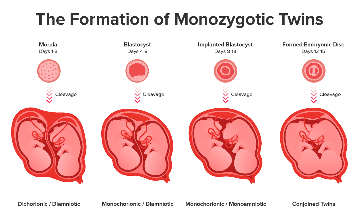 A diagram showing four ways monozygotic twins are formed, depending on the timing of the separation and duplication of cells. The first illustration in the diagram shows a morula with cleavage at days 1 to 3 and results in dichorionic / diamniotic formation (separate placenta, separate amnion). The second illustration in the diagram shows a blastocyst with cleavage at days 4 to 8 which results in monochorionic / diamniotic formation (sharing the same placenta but having separate amnions). The third illustration in the diagram shows an implanted blastocyst with cleavage at days 8 to 13 which results in monochorionic / mono amniotic (shared placenta and shared amnions). The fourth illustration in the diagram shows a formed embryonic disc with cleavage at days 13 to 15, which in this figure leads to conjoined twins (shared placenta, shared amnions, and bodies fused).