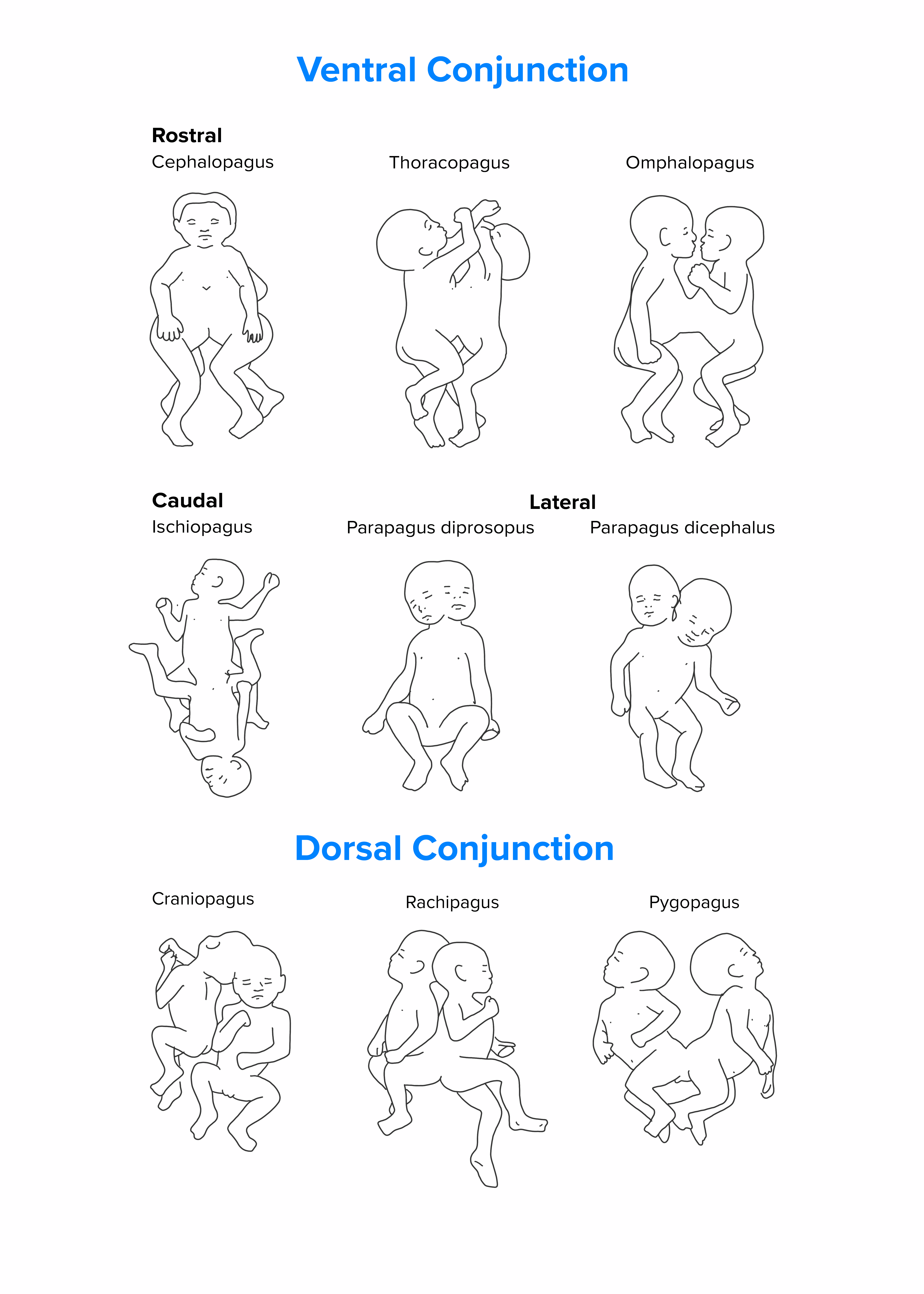 Images of the different types of conjoined twins. They are illustrated in two rows. In the top row there is cephalopagus, thoracopagus, omphalopagus, parapagus dicephalus, parapagus diprosopus, ischiopagus, craniopagus, and rachipagus.