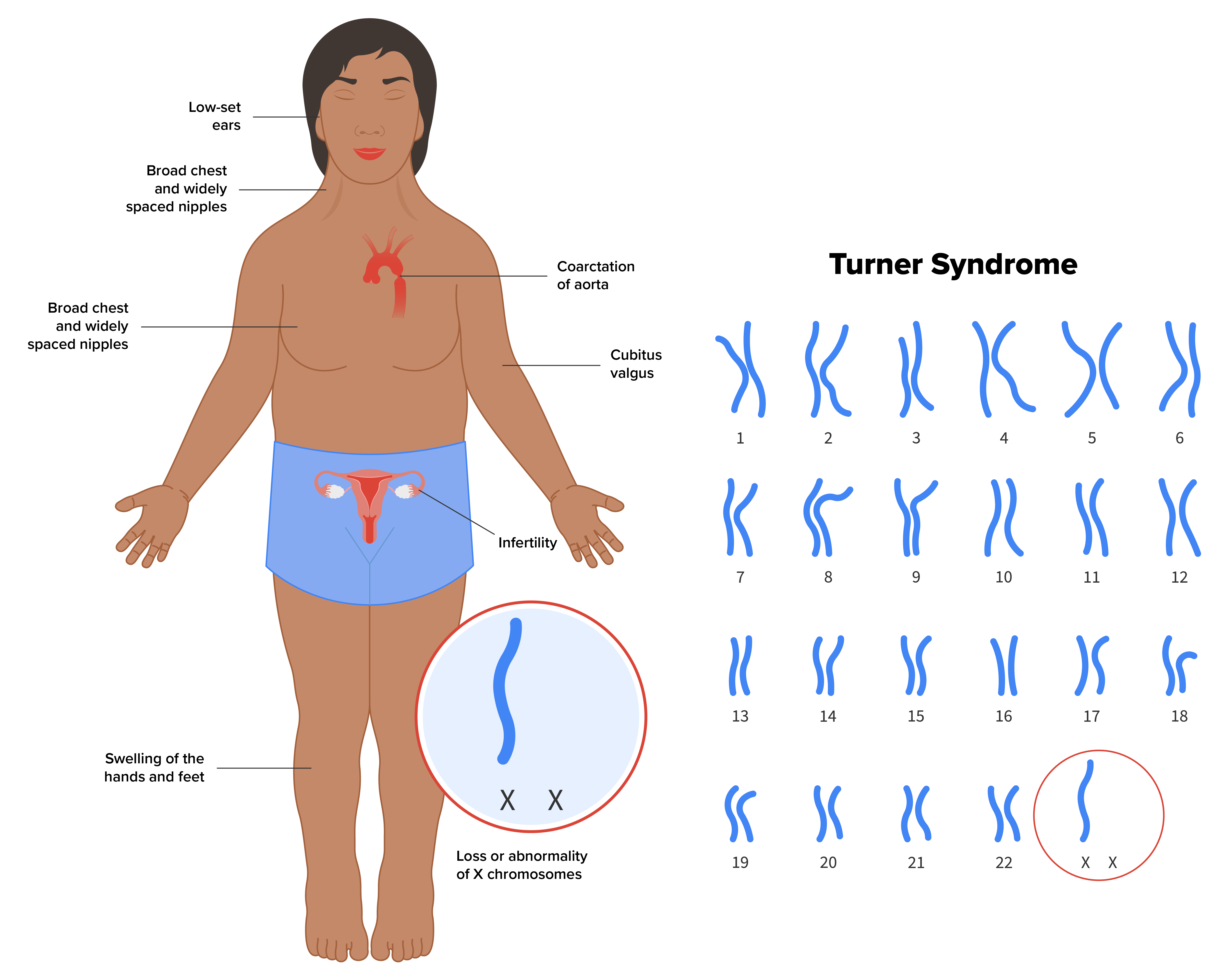 Diagram of a person with Turner syndrome. On the left there is the image of the person with the characteristics of Turner syndrome. The characteristics are low set ears, webbed neck, broad chest and widely spaced nipples, swelling of the hands and feet, loss or abnormal X chromosomes, infertility, cubitus valgus, and coarctation of the aorta. On the right the image shows all of the chromosomes of Turner syndrome and that the second x chromosome is missing.