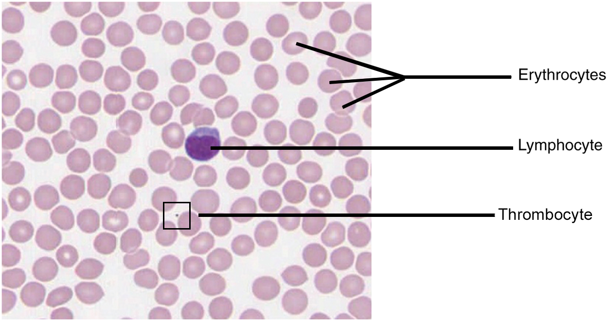 This micrograph of a blood smear shows a group of red blood cells and a single white blood cell. The red cells are small discs that have a slight depression at their centers with no nuclei present. The white blood cell is larger and more darkly stained and has a large, prominent nucleus that is also darkly stained.