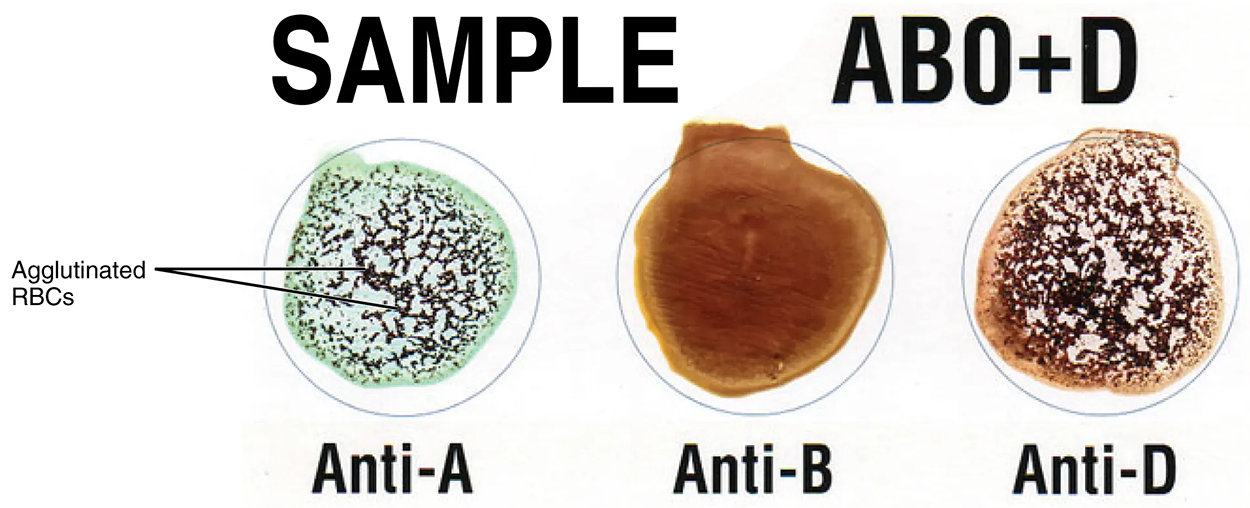 Cross Matching Blood Types - This sample of a commercially produced “bedside” card enables quick typing of both a recipient’s and donor’s blood before transfusion. The card contains three reaction sites or wells. One is coated with an anti-A antibody, one with an anti-B antibody, and one with an anti-D antibody (tests for the presence of Rh factor D). Mixing a drop of blood and saline into each well enables the blood to interact with a preparation of type-specific antibodies, also called anti-seras. Agglutination of RBCs in a given site indicates a positive identification of the blood antigens, in this case, A and Rh antigens for blood type A⁺. For the purpose of transfusion, the donor’s and recipient’s blood types must match. The three reaction sites are visible each coated as captioned.