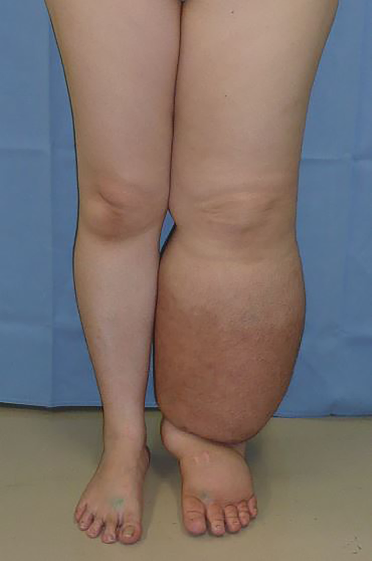 Lower leg lymphedema, shown are two legs from the same individual.  One leg is normal the other is two to three sizes larger due to swelling.
