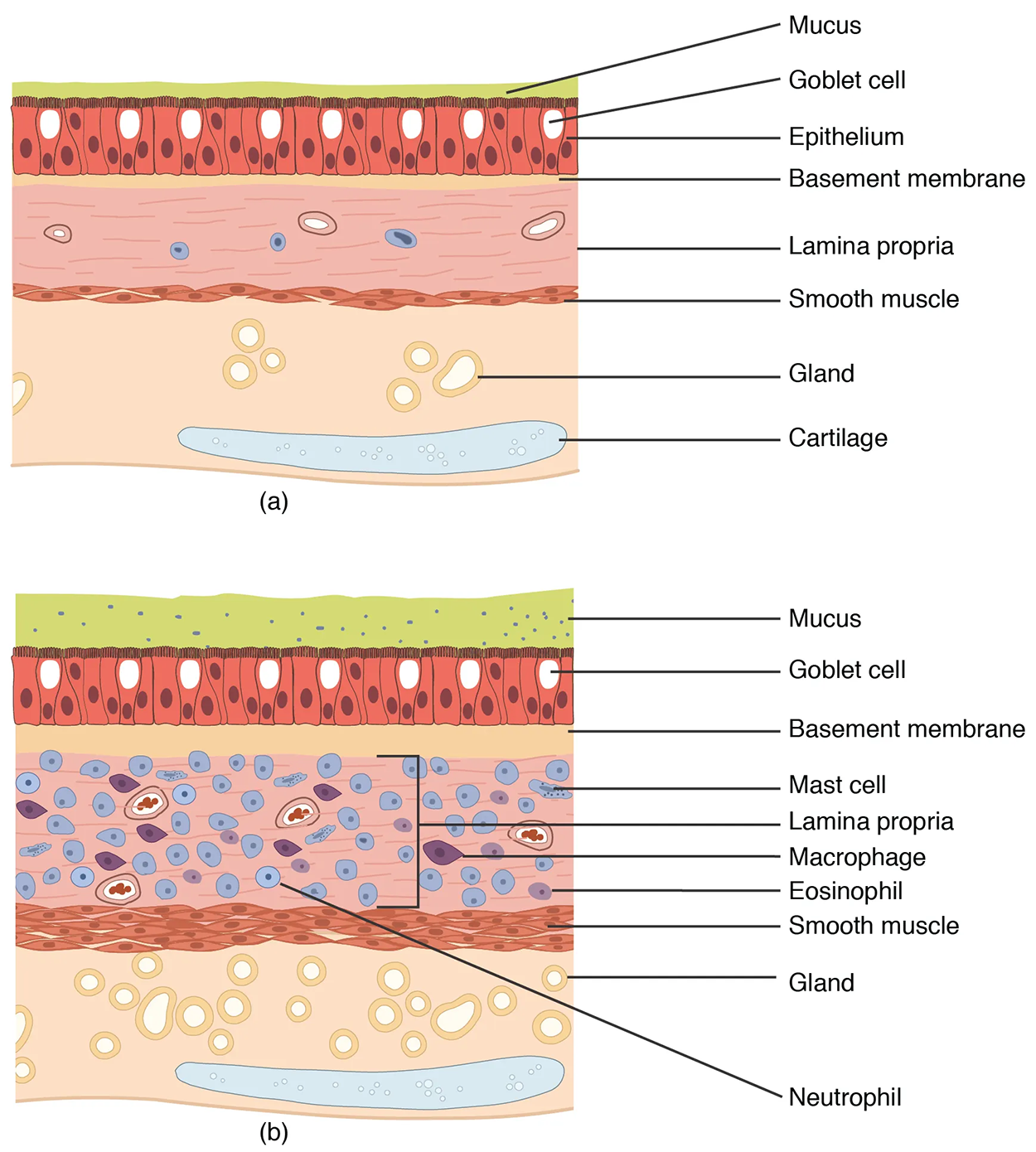 Normal and Bronchial Asthma Tissues - (a) Normal lung tissue does not have the characteristics of lung tissue during (b) an asthma attack, which include thickened mucosa, increased mucus-producing goblet cells, and eosinophil infiltrates. The top panel of this figure shows normal lung tissue, and the bottom panel shows lung tissue inflamed by asthma.