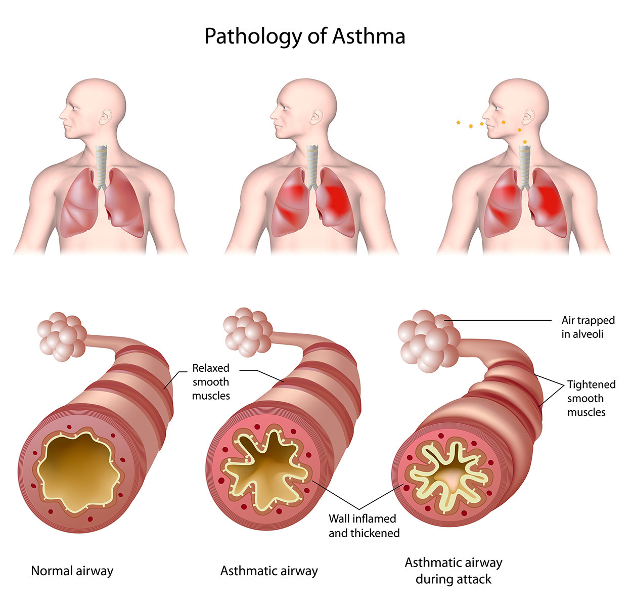 Pathology of Asthma - Lungs and airways are shown in an individual who is not affected by asthma (left), in an individual who is affected by asthma but is not actively having an asthma attack (middle), and in an individual during an asthma attack (right). Three illustrations of an individual each with a top image of the lungs and a bottom image of the airways. The first (on the left) includes clear lungs and a normal airway which has relaxed smooth muscles and walls that are clear and unobstructed. The second illustration (middle) shows lungs that are inflamed and whose airways still have relaxed smooth muscles but whose walls are inflamed and thickened. The final illustration (on the right) shows inflamed lungs with expellants from the mouth, the airway’s smooth muscles have tightened, the walls are inflamed and thickened, and the air is being trapped in the alveoli.