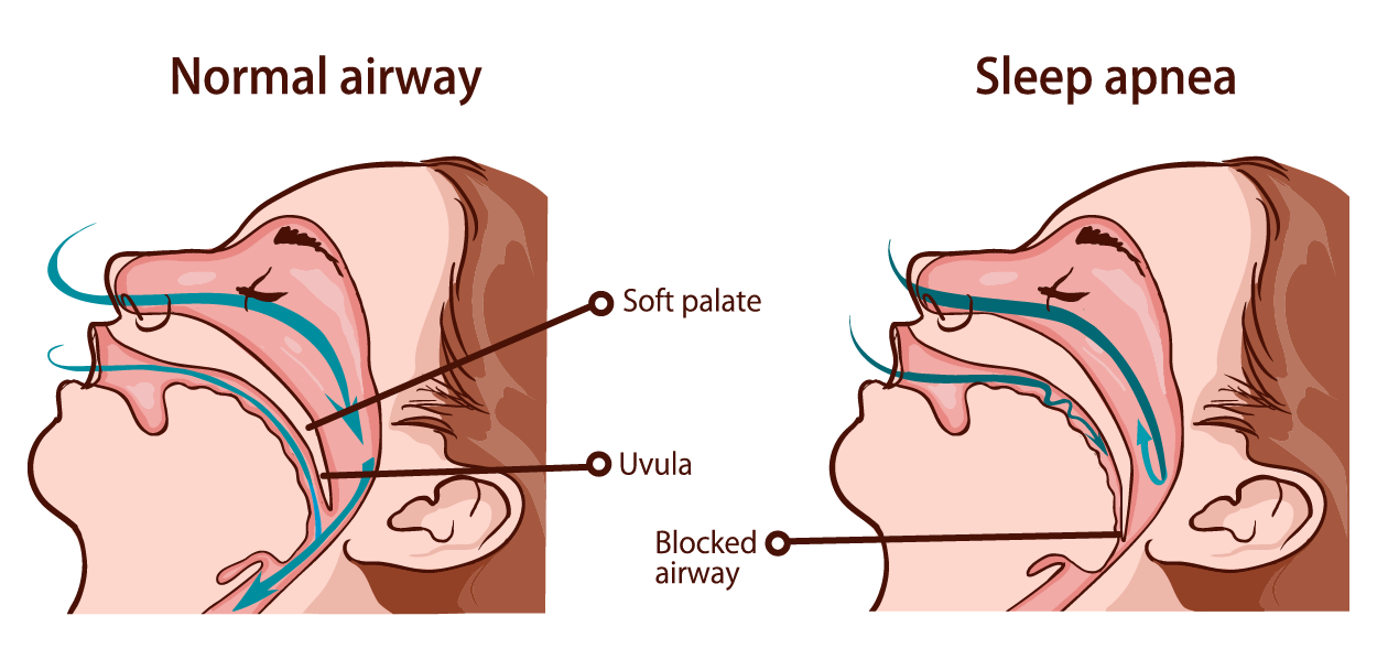 Two illustrations of an individual sleeping.  On the left air is taken in through the nose and mouth (use of arrows) and passes by the soft palate.  The uvula is open and the air continues down into the lungs. In the illustration on the right, the soft palate is closed and there is a blocked airway.
