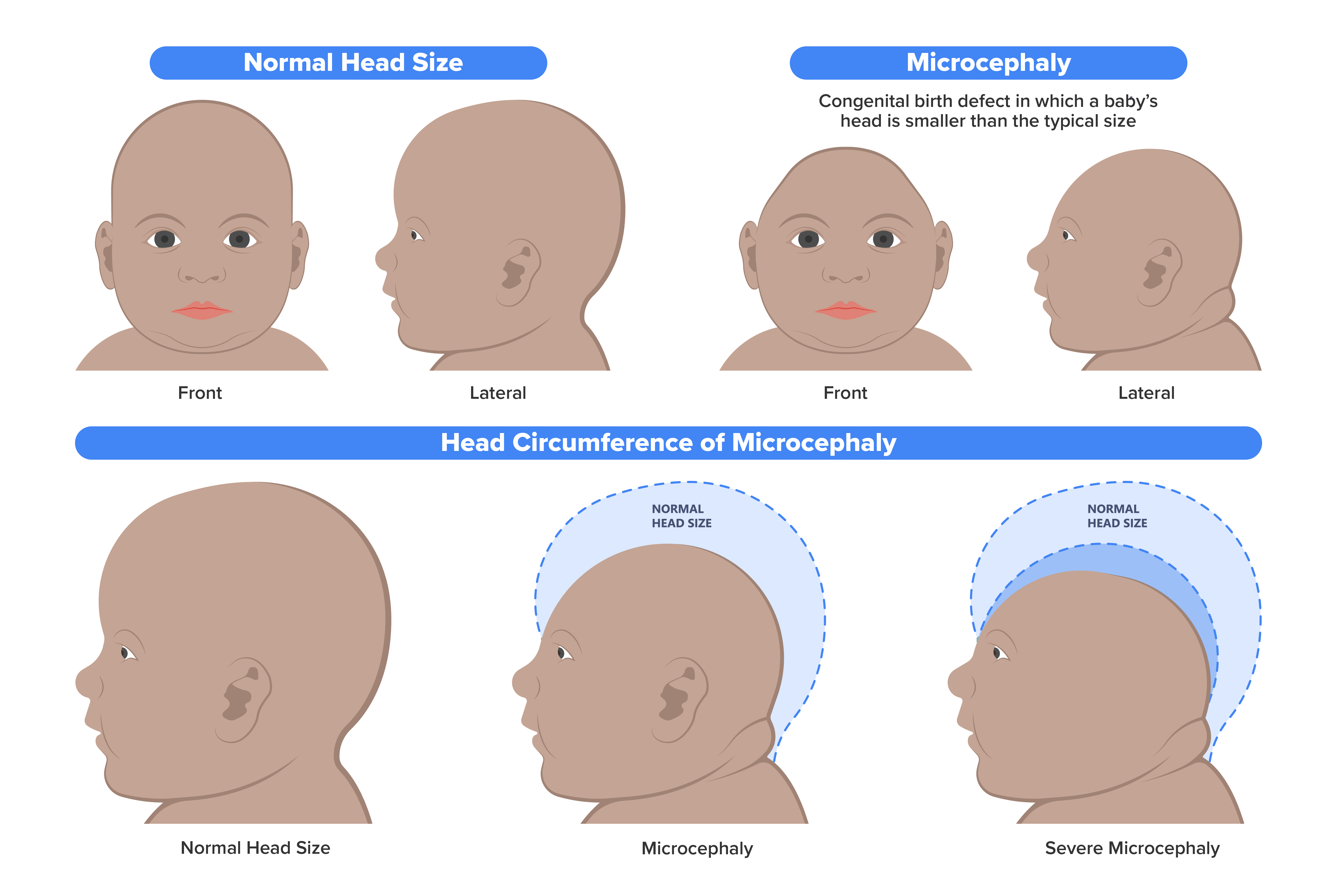 Top right illustration is a front and lateral view of a normal head size of a baby. On the left is the front and lateral view of the microcephaly-affected baby.  The congenital birth defect in which a baby’s head is smaller than the typical size.  On the bottom of the illustration are three lateral views of different babies' heads with the title head circumference of microcephaly.  The baby's head on the right is normal head size.  The baby in the middle’s head shows microcephaly compared to a normal head size.  The baby on the right’s head shows severe microcephaly compared to normal head size.