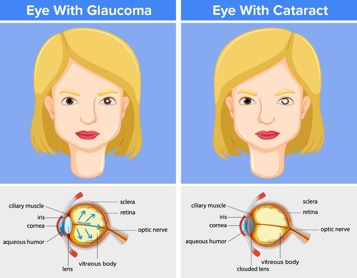 An illustration that shows an eye with glaucoma and an eye with cataracts. The image shows the difference between what they look like.