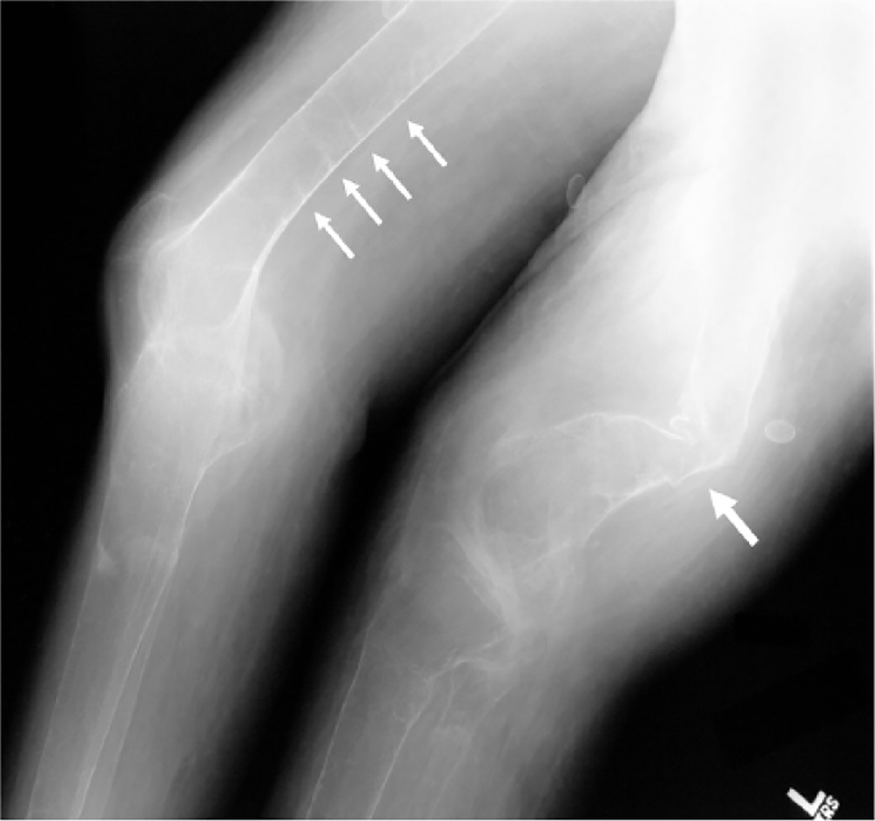 Result of Severe Osteomalacia - A radiograph of the distal femurs shows further evidence of badly malformed bones secondary to severe osteomalacia (large arrow), as well as several additional pseudofractures (small arrows).