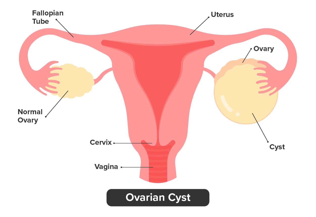 An Ovarian Cyst Illustration shows a cyst growing on the right side ovary. It is round and below the ovary.