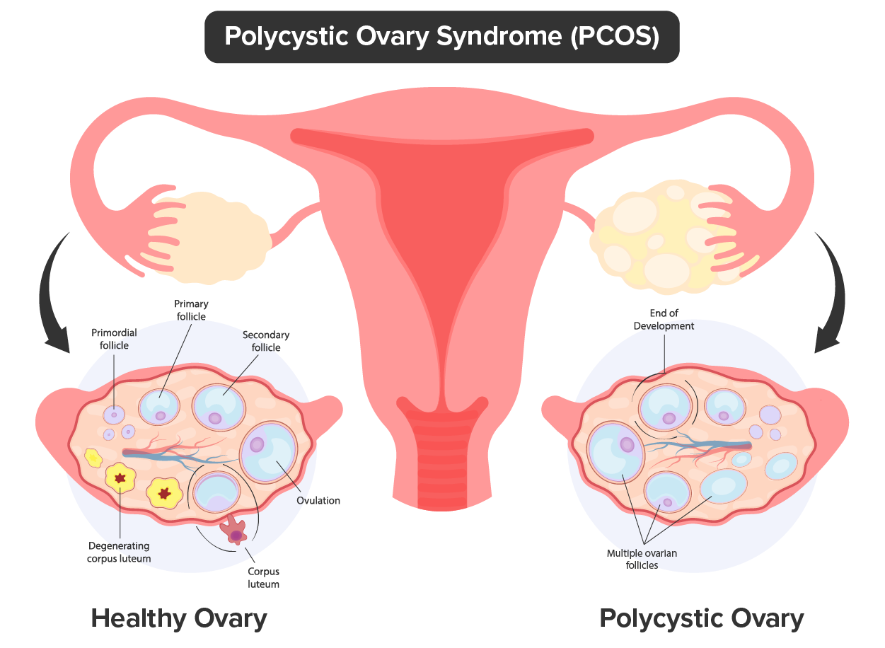 Polycystic Ovarian Syndrome (PCOS) Illustration of the female reproduction organs. The left shows a blowup of a healthy ovary. Inside the ovary, we see (in a clockwise pattern) the primordial follicle, then the primary follicle, then the secondary follicle, finally ovulation, which is followed by corpus luteum, the ovarian follicle, the degenerating corpus luteum, and finally corpus albicans. On the right side, there is a blown-up diagram of a polycystic ovary. Inside this ovary we see (in a counter-clockwise pattern) the primordial follicle, then the primary follicle, then secondary follicle which has the label “end of development” surrounding it, next we see multiple ovarian follicles.