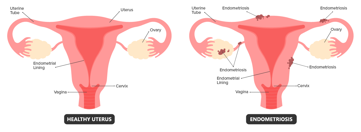 Comparison of a Healthy Uterus and a Uterus with Endometriosis - Endometriosis occurs when endometrial-like tissue forms outside of the uterus. Illustration that shows a healthy uterus on the left side and a uterus with endometriosis on the right. Endometriosis tissue is shown on the outside top of the uterus, on the outside of the uterine tube, on the side of the ovary, and on the right outer side of the uterus.