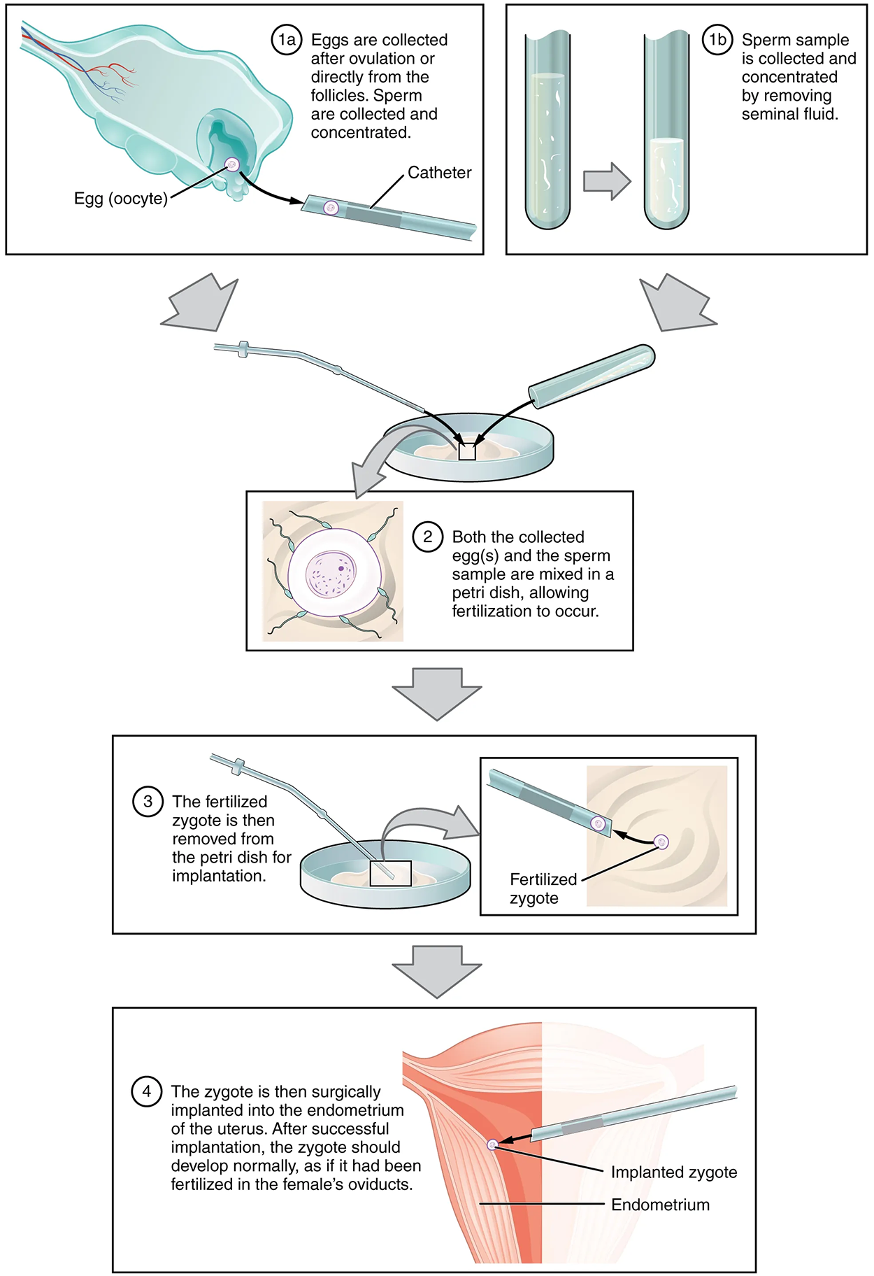 This multi-part figure shows the different steps in in vitro fertilization. The top panel shows how the oocytes and the sperm are collected and prepared. The next panel shows the sperm and oocytes being mixed in a petri dish. The panel below shows the fertilized zygote being prepared for implantation. The last panel shows the fertilized zygote being implanted into the uterus.