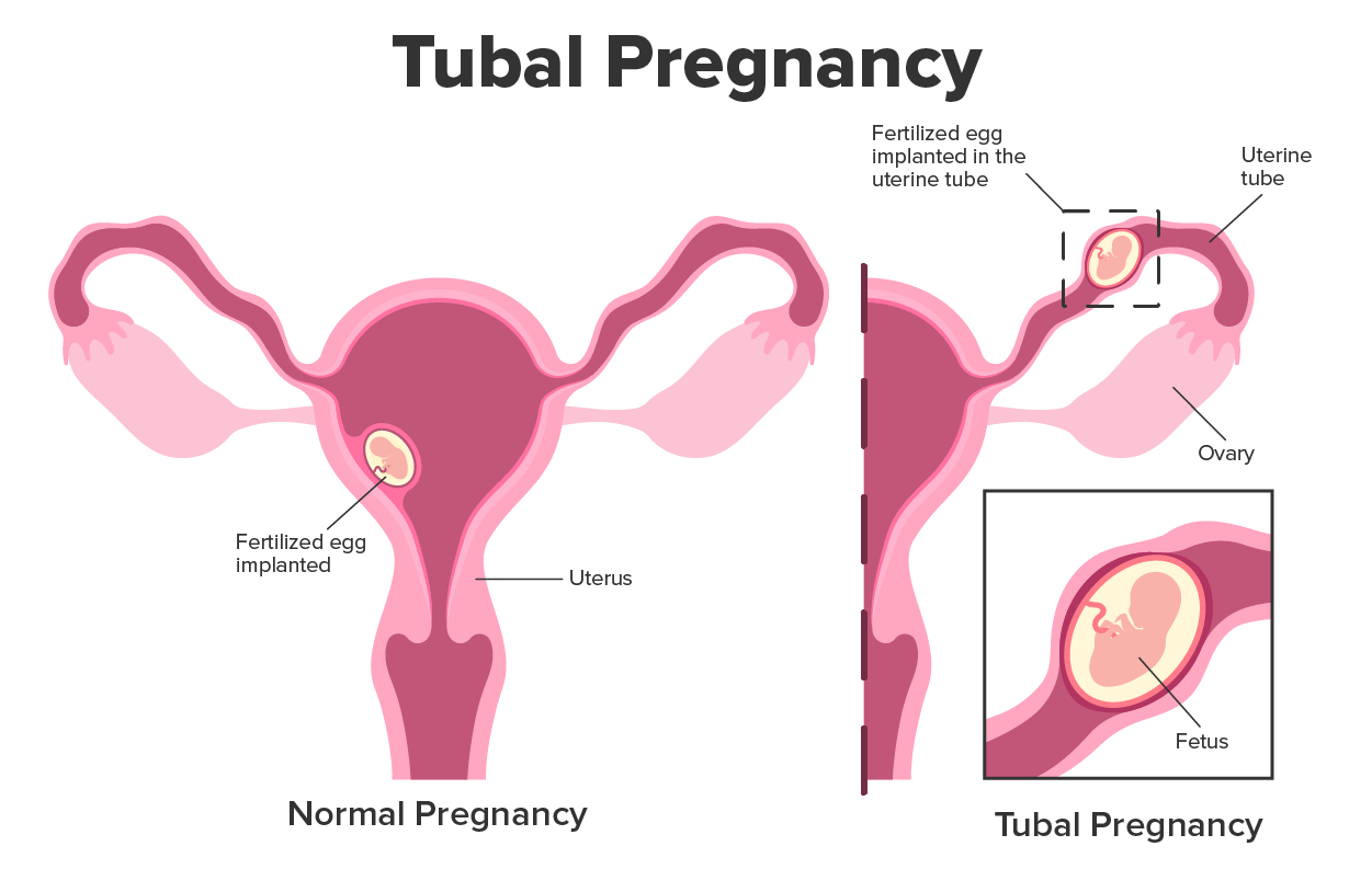 Illustration shows normal pregnancy with the fertilized egg implanted on the uterine wall.  It also shows a tubal pregnancy with the fertilized egg implanted in the uterine tube.