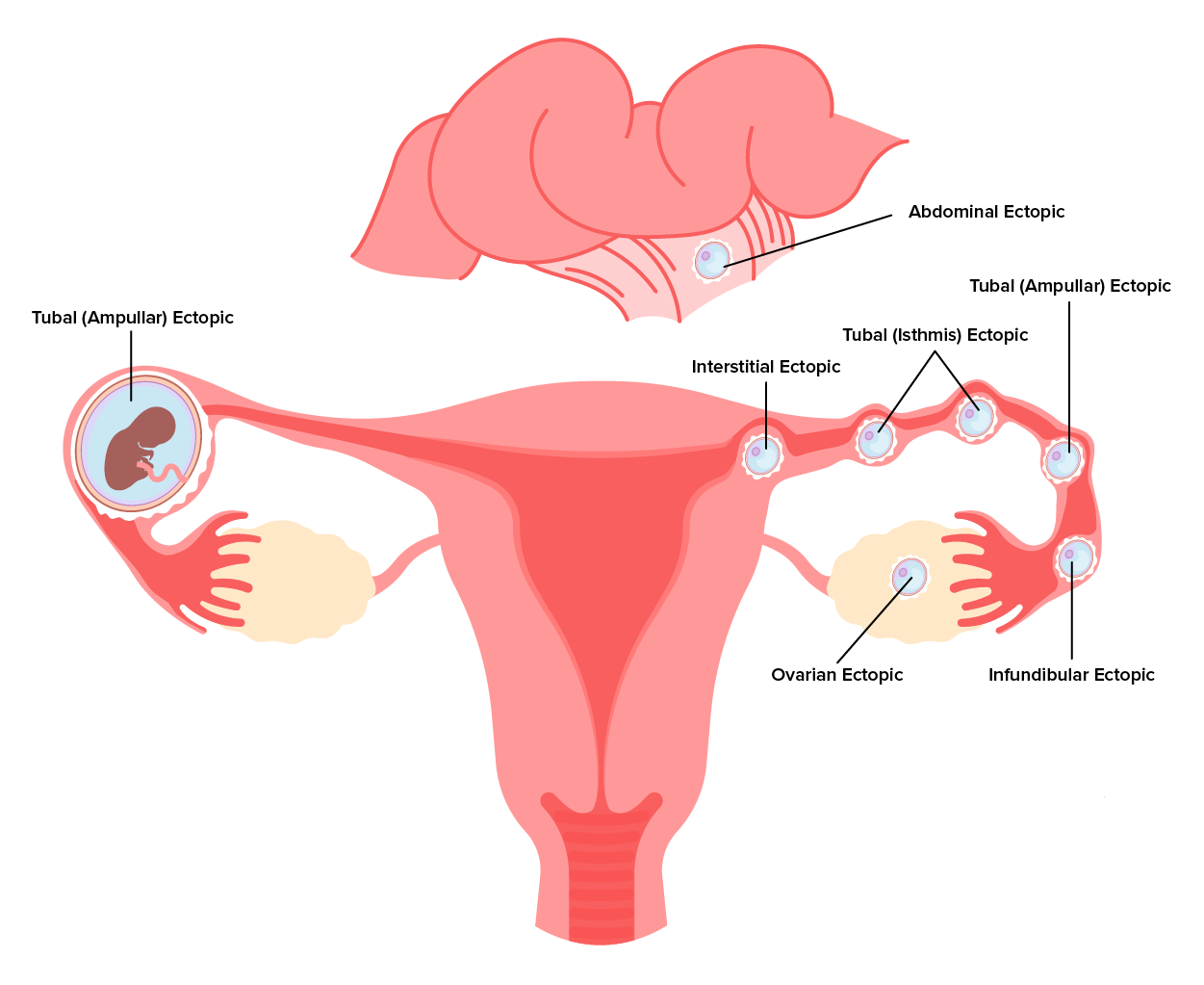 Image of the various possible locations of an ectopic pregnancy within the uterus, ovaries, and fallopian tubes. Labeled locations are tubal (ampullar) ectopic, Interstitial ectopic, abdominal ectopic, tubal (isthmic) ectopic, infundibular ectopic, and ovarian ectopic.