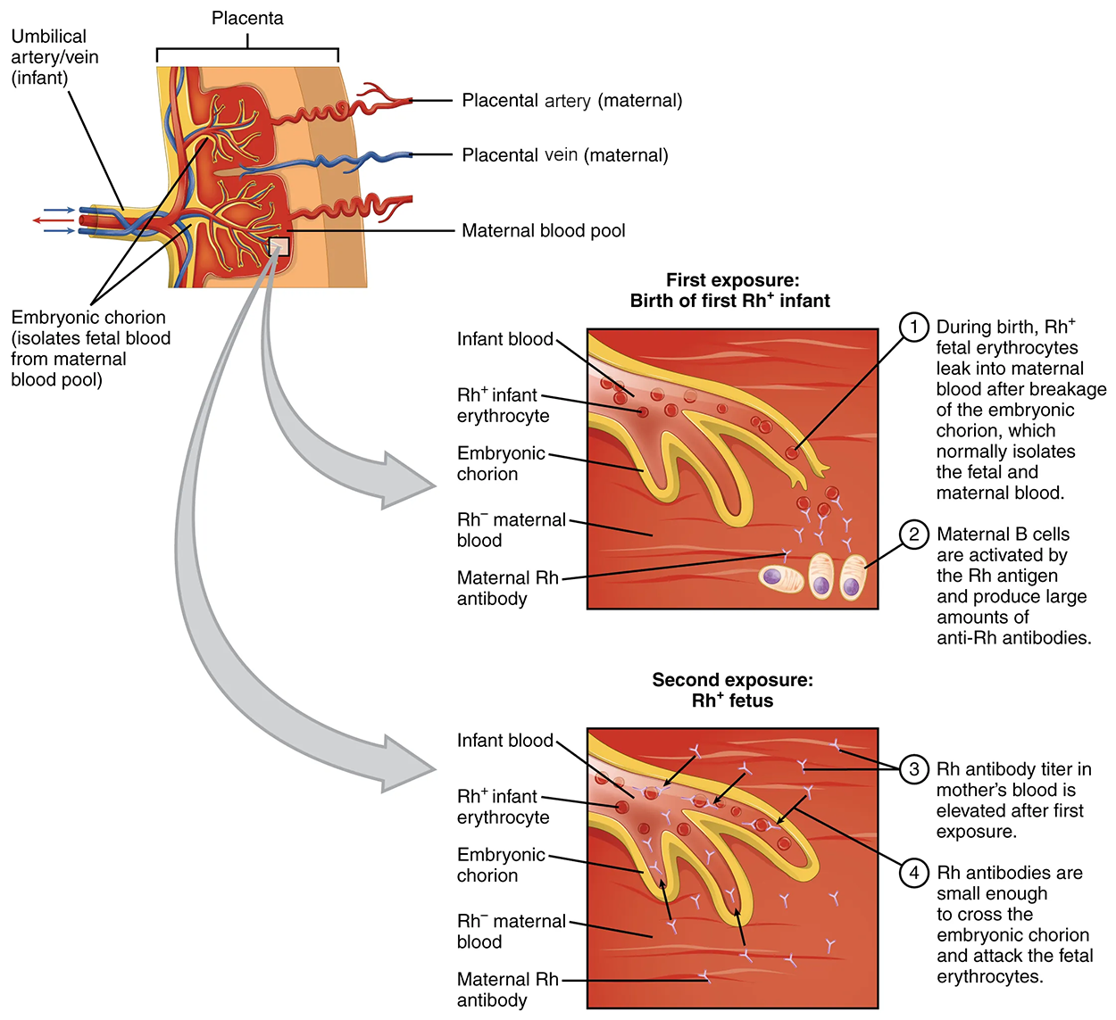 Erythroblastosis Fetalis—The first exposure of an Rh⁻ person to Rh⁺ erythrocytes during pregnancy induces sensitization. Anti-Rh antibodies begin to circulate in the pregnant person's bloodstream. A second exposure occurs with a subsequent pregnancy with an Rh⁺ fetus in the uterus. During that subsequent pregnancy, the pregnant person's anti-Rh antibodies may cross the placenta and enter the fetal bloodstream, causing agglutination and hemolysis of fetal erythrocytes.