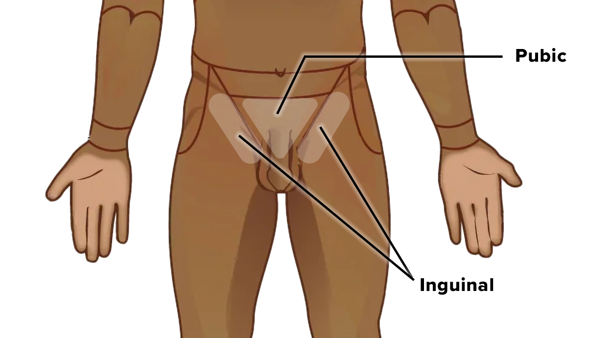 Diagram of the lower torso and upper legs showing labeled anatomical regions: Pubic (lower central abdomen above the genital area) and Inguinal (left and right sides where the thighs meet the torso).