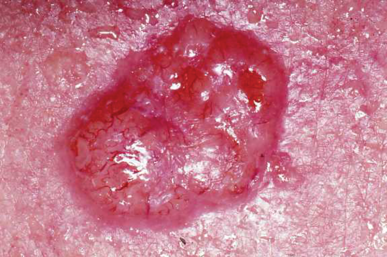 basal cell carcinoma, showing its typical features of waxy, pearly bumps or flat, flesh-colored lesions often occurring on the skin.
