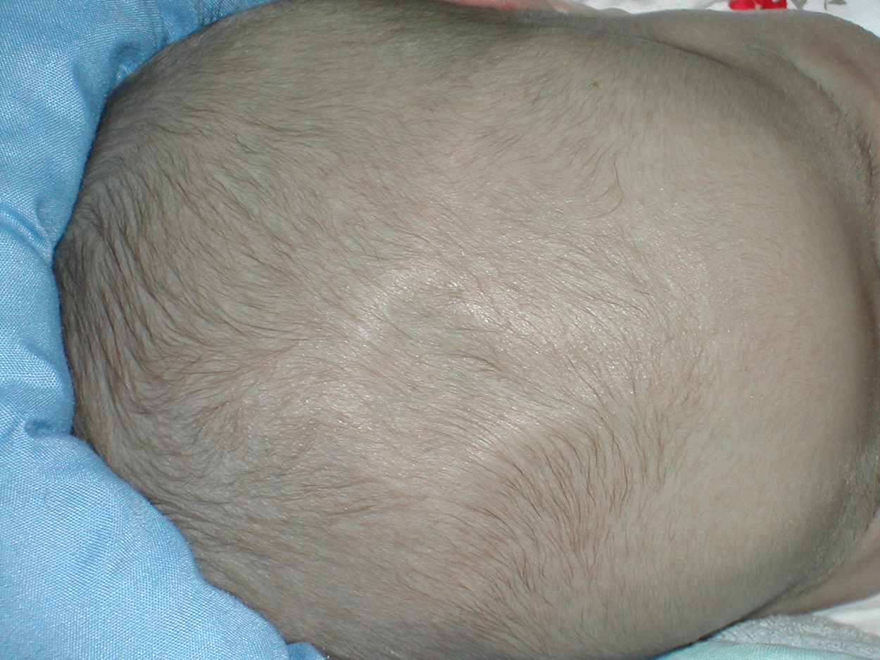 A top view of a newborn baby’s head. There is a slight depression visible near the middle of the baby’s head.