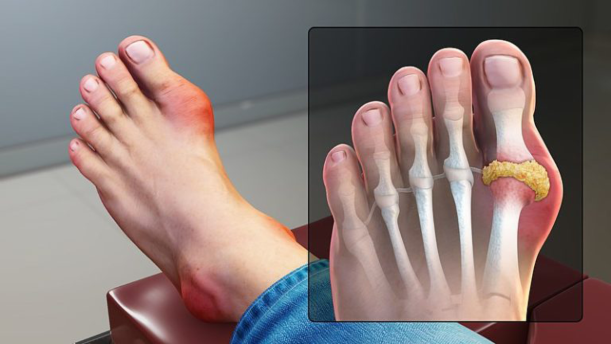 A photo and an illustration show gout. The photo shows a foot with a swollen, reddened joint at the base of the big toe. The illustration shows a similar foot with the bones visible and a thickened, swollen region at the base of the big toe.