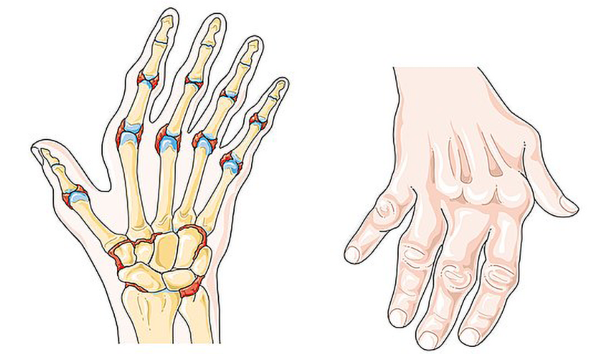 An outline of a hand shows the hand bones inside. The fingers angle to the right, away from the thumb. To the right, a similar hand is shown covered in skin.