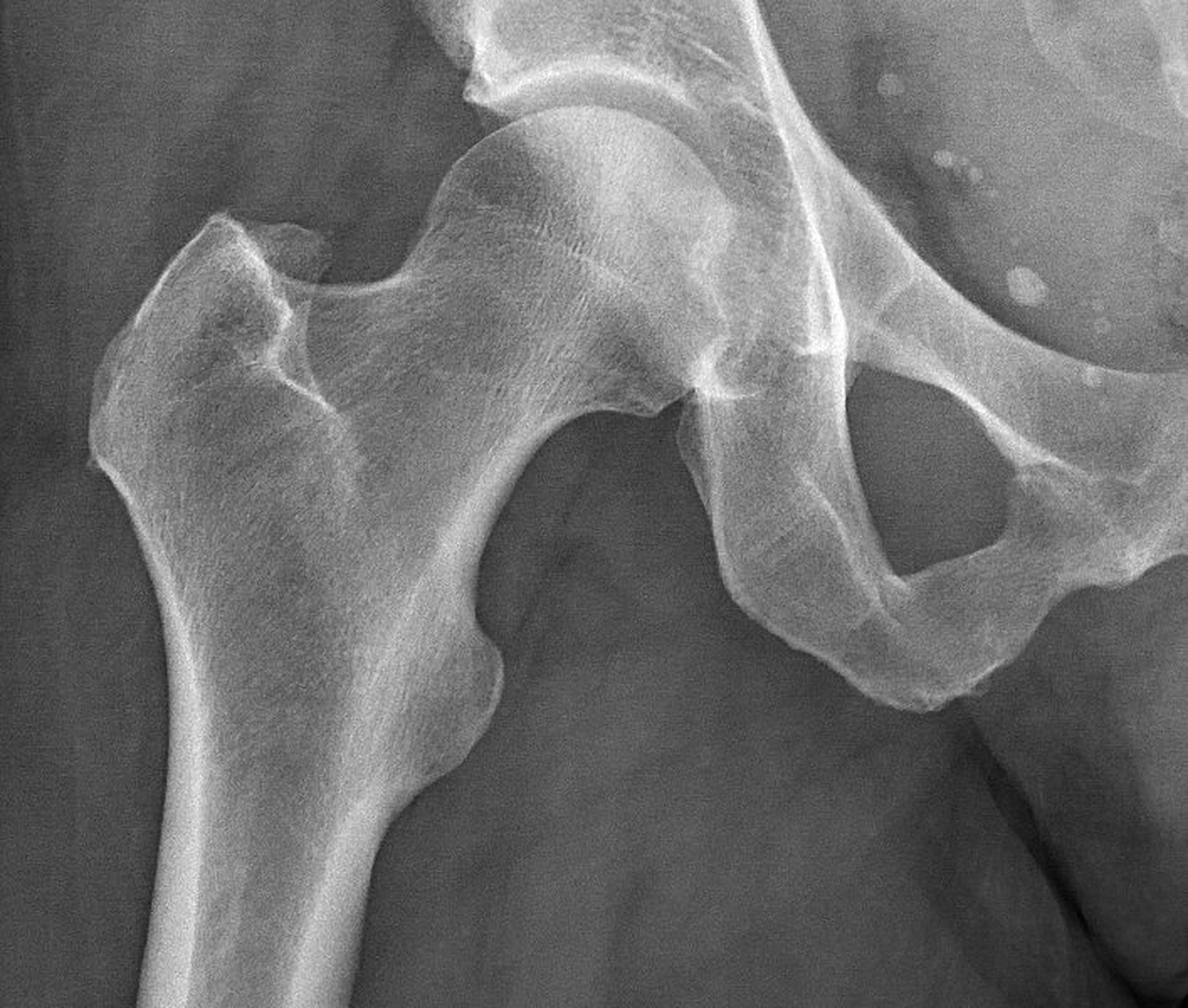 An X-ray shows white bones against a gray to black background.