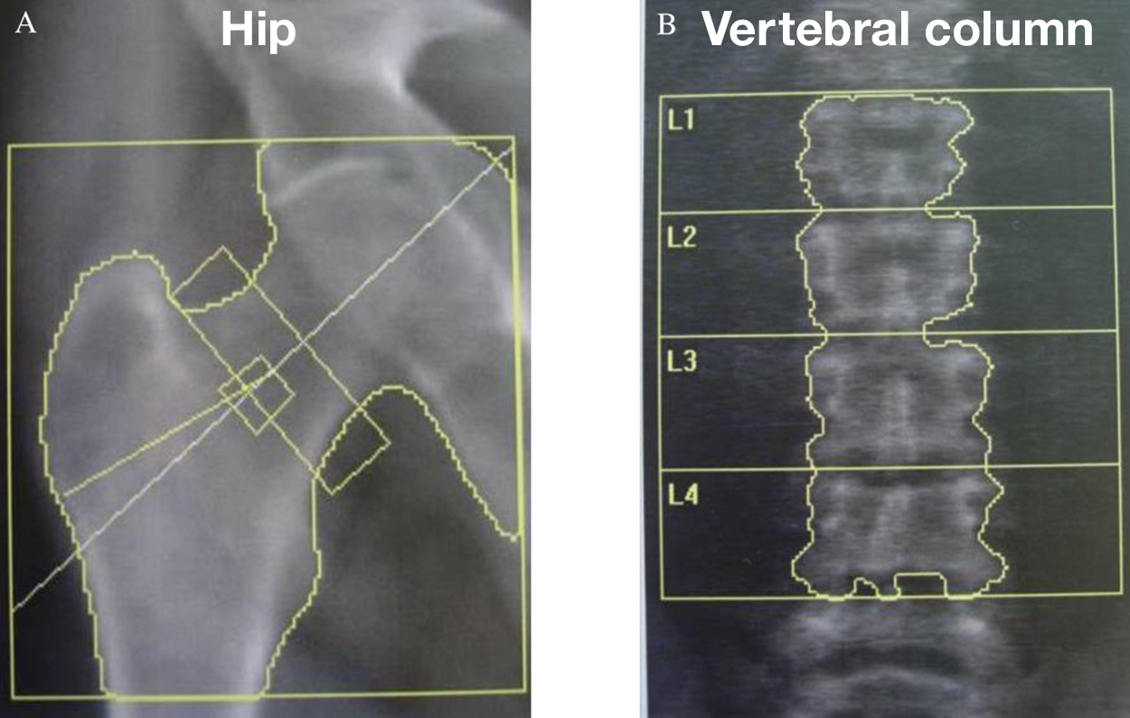 The left-hand image shows a hip and a right-hand image shows part of a vertebral column. Lines on the scans outline bones, and the vertebrae are labeled as L1 to L4.