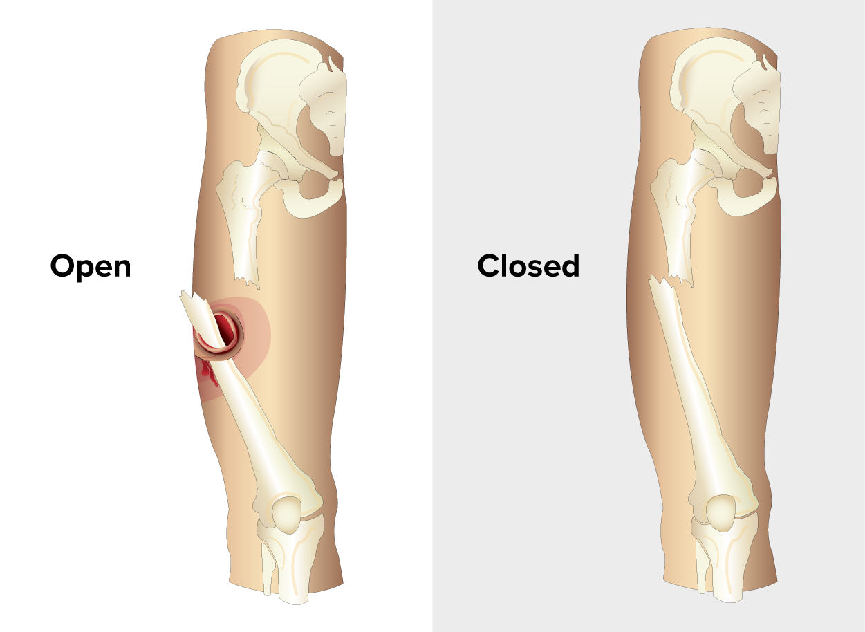Two illustrations of an upper leg, each containing a broken femur. The left-hand femur has a lower half that angles up and through a reddened skin wound. The right-hand femur has a similar break, but the skin is intact.