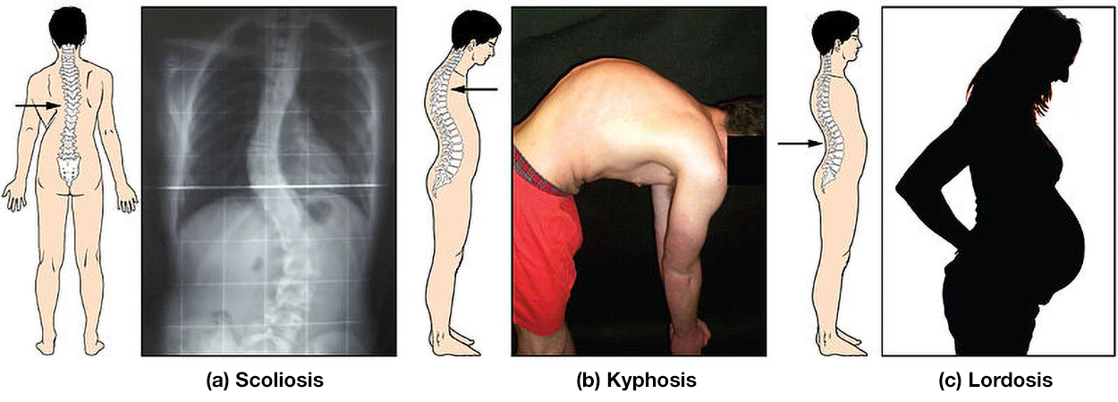  Spinal curvatures. In an illustration and an x-ray, scoliosis is shown as a spine that curves slightly to the right and back in the midback. In a photo of a man bending and an illustration, kyphosis is shown as producing a curve in the upper spine that produces a small hump below the neck. In an illustration, lordosis is shown as a spine that curves inward more than usual at the lower back. An accompanying illustration shows a pregnant woman with her hands on the curve at her lower back.