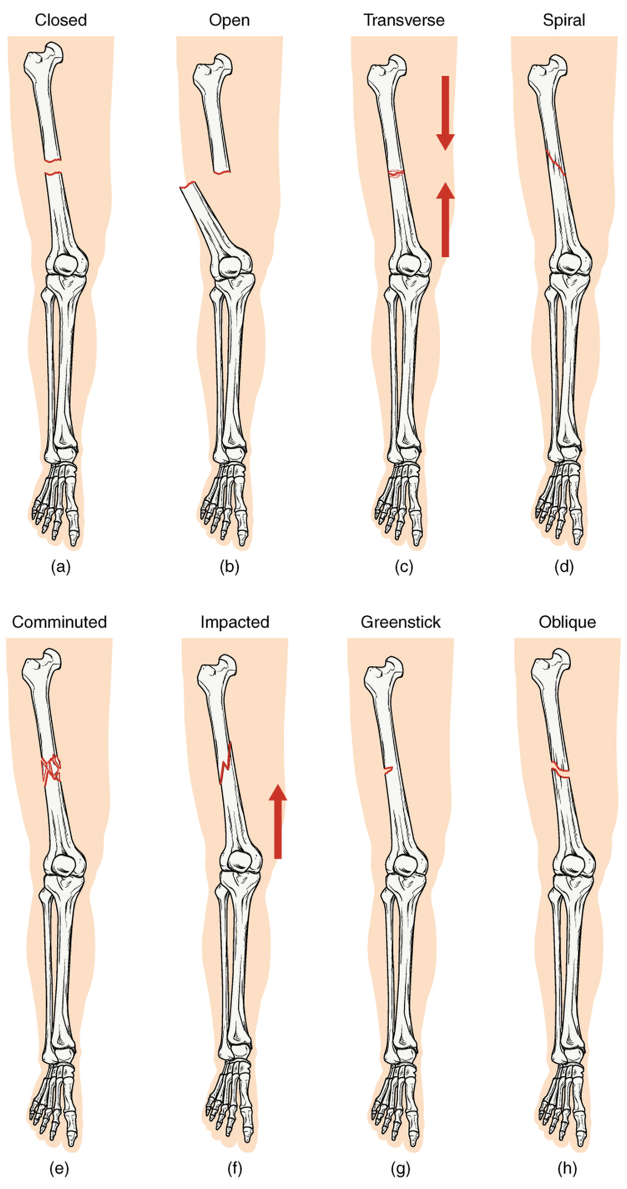An illustration shows eight types of fractures. A closed fracture does not break the skin; an open fracture does break the skin; a transverse fracture is a small, horizontal break with arrows showing vertical forces from above and below; a spiral fracture is angled. A comminuted fracture has a complex mesh of breaks; an impacted fracture is angled with an upward-pointing arrow showing force from below; a greenstick fracture is a partial break; and an oblique fracture is angled.