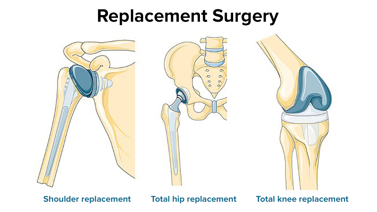 Three replacement surgeries. A shoulder replacement replaces parts of the ball-and-socket shoulder joint, a total hip replacement replaces the head of the femur that inserts into the hip, and a total knee replacement replaces parts of the knee joint where articulation occurs.