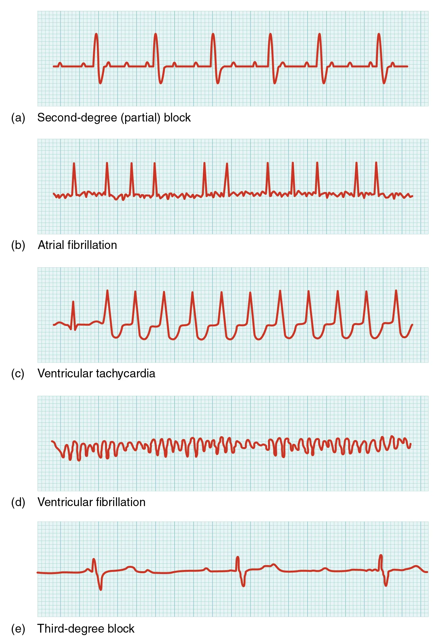An illustration shows second-degree (partial block in part a, atrial fibrillation in part b, ventricular tachycardia in part c, ventricular fibrillation in part d, and third-degree block in part e.