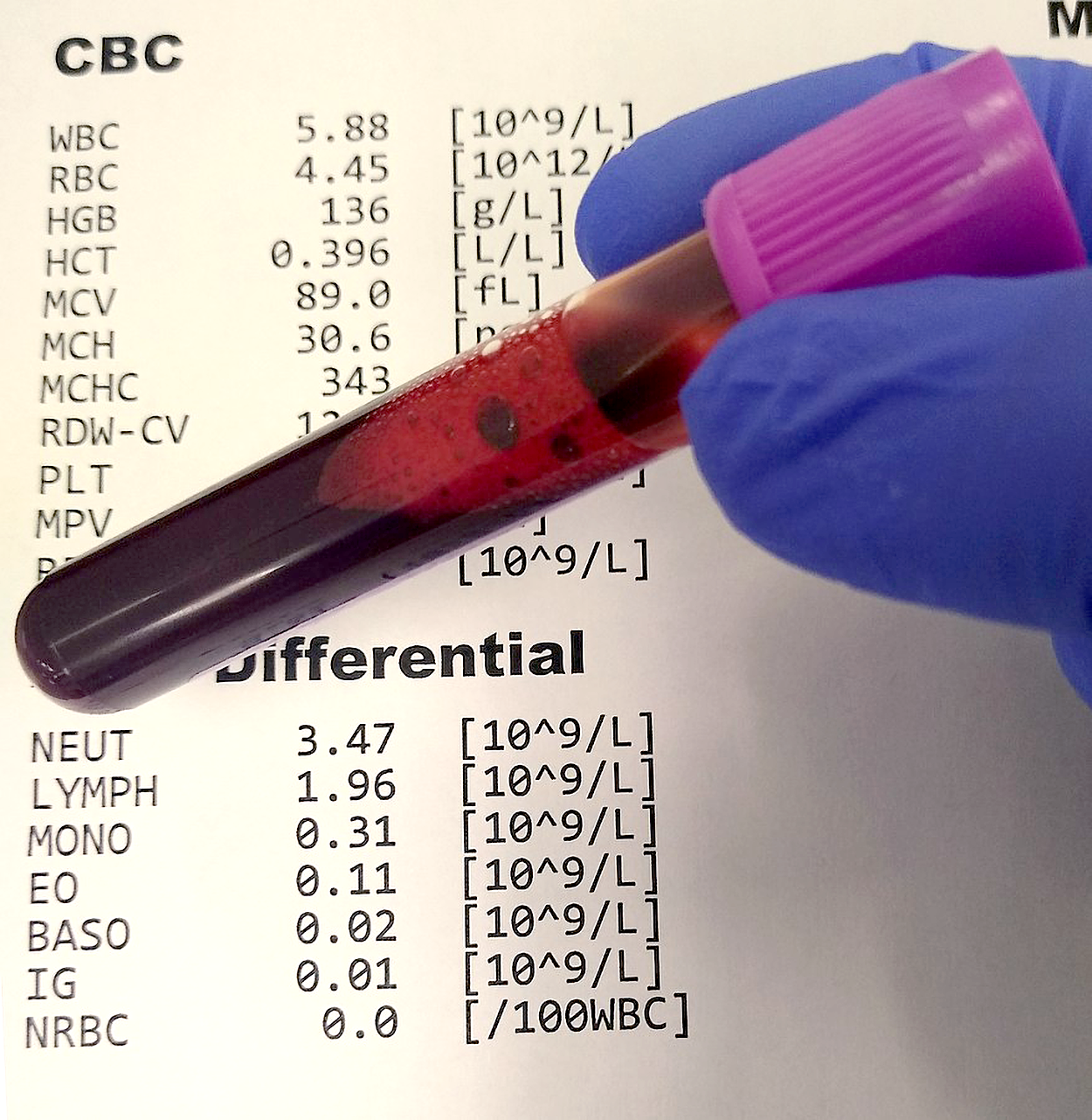 The test shows values for the CBC of WBC, RBC, HGB, HCT, MCV, MCH, MCHC, RDW-CV, PLV, MPV, and one more hidden behind a tube of blood. The test also shows values for the differential of Neut, Lymph, Mono, EO, Baso, Ig, NRBC.