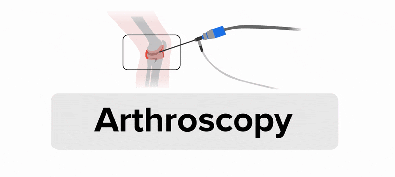 An anatomical drawing of a knee joint on the right is shown along with a scope on the left that has a long, narrow tubed instrument entering the knee joint. Below the drawing is the word ‘Arthroscopy’. The picture splits apart to first show only the highlighted knee joint on the right, with the word prefix ‘Arthr/o’ appearing below it. Underneath the prefix ‘Arthr/o’ appears a blue oval with white text saying ‘Combining form: Joint’. Then, the scope on the left appears with the suffix ‘-scopy’ appearing below it. Underneath the suffix ‘-scopy’ appears a purple oval with white text saying “Suffix: Visual examination”. The two pictures then join back together to show the scope entering the knee joint as initially depicted, again with the word ‘Arthroscopy’ below it.