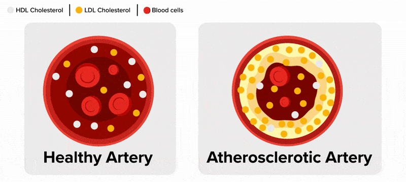 Two different cross-sections of arteries are shown side-by-side, with both depicted as red circles, with round red blood cells floating through them as well as smaller yellow circles. In the top left corner, a visual key shows a yellow circle with the text ‘LDL Cholesterol’ to identify what the yellow circles inside the artery represent, and a red circle with the text ‘Blood cells’ to identify what the red circles inside the artery represent. The artery on the left is labeled ‘Healthy Artery’ and has smooth, red walls. The artery on the right is labeled ‘Atherosclerotic Artery’ and has walls that are covered in a layer of light yellow and light orange plaque around the inside perimeter, making the inside diameter of the artery smaller. Both artery depictions fade out, and the visual key at the top left remains. On-screen appears a diagonal cross section of an artery showing it as cylindrical with part of it cut away so that freely flowing LDL cholesterol as yellow circles and red blood cells as red circles are visible. Inside the cylindrical walls of the cylinder, a lumpy yellow layer begins to come down from the top wall and the bottom wall to create a narrowing of the artery. A text label points to this on screen with the words ‘Fatty Plaque Buildup’. The text ‘Reduced Blood Flow’ appears under this text, as the red blood cells in the artery begin to slow down as they collide with the yellow plaque on the walls and form clumps. Text appears to the top left of the artery, under the visual key, that says ‘Atherosclerosis narrows arteries and restricts blood flow’.