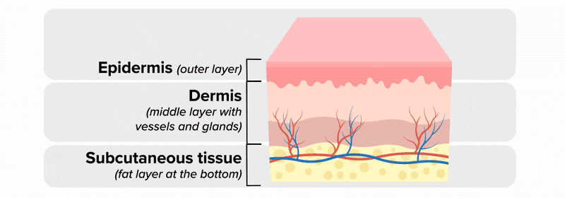 A cross-sectional of skin is depicted as a cube with three layers. The text ‘Epidermis (outer layer)’ points to the top layer of skin, depicted as pink and smooth. The text ‘Dermis (middle layer with vessels and glands)’ points to the middle layer of skin, depicted as a thicker wavy light pink line atop a slightly thinner wavy darker pink line. The text ‘Subcutaneous tissue (fat layer at the bottom)’ points to the third and bottom layer of skin, depicted as a thicker light yellow wavy line with small darker yellow circles throughout. There are two wavy horizontal lines that are superimposed over this layer, where one line is red and the other line is blue, and both lines have branches coming up vertically from them to depict the circulatory system’s place in the skin. The image of the cube of skin shifts over to the left and the text disappears except for the labels ‘Epidermis’, ‘Dermis’, and ‘Subcutaneous tissue’ still pointing out the respective areas of the skin. The word ‘Epidermis’ remains bold while the words ‘Dermis’ and ‘Subcutaneous tissue’ fade out slightly. A burn to the epidermis is shown, depicted as a darker pink irregular shape atop the pink and smooth layer of skin. A pink square with rounded corners shifts in from the right that contains the text ‘Superficial Burn (First Degree) – Affects the outermost skin layer. Heals without scarring’. This pink square and its containing text shifts out to the right. Next, the words ‘Epidermis’ and ‘Dermis’ remain bold while the words ‘Subcutaneous tissue’ fades out slightly, as a burn to the epidermis and dermis is shown, depicted as a darker pink irregular shape with smaller pink bubbling circles that is atop the pink and smooth layer of skin and extending down into the first wavy light pink line of the second layer of skin. At the same time, a darker pink square with round corners shifts in from the right that contains the text ‘Partial-Thickness Burn (Second Degree) – Involves both the epidermis and dermis. May scar’. This darker pink square and its containing text shifts out to the right. Next, all three words remain bold: ‘Epidermis’, ‘Dermis’ and ‘Subcutaneous tissue’, as a burn to all three layers of skin is shown, depicted as a maroon irregular shape with smaller, darker maroon irregular flat shapes inside, atop the pink and smooth layer of skin and extending down into the third layer of skin that was depicted as the thicker light yellow wavy line. At the same time, a dark pink square with round corners shifts in from the right that contains the text ‘Full-Thickness Burn (Third degree) – Eschar, necrosis’. All text fades out and the cube of skin, still with the depicted full-thickness burn, shifts to the left of the screen. An arrow accompanies the animation of the damaged maroon portion of skin lifting off the remaining healthy skin, while the following text on screen appears inside a light gray box: ‘Debridement – removal of dead tissue’.