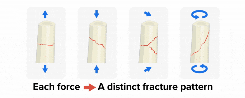 Centered text is shown that reads ‘Forces That Cause Bone Fractures’ and underneath is an illustration of a long bone displayed horizontally in the center of the screen, spanning most of the screen. The long bone twists clockwise to rotate vertically, then the screen zooms in to just the center of the bone, which appears on-screen as a vertical cylinder depicted just as a portion of the bone. The text ‘Tension’ appears, with a blue arrow each at the top and bottom of the bone pointing away from each other. The arrows pulse away from each other as depicting opposing forces on the bone, and a jagged red crack appears horizontally across the center of the bone, while the text ‘Transverse Fracture’ appears.
