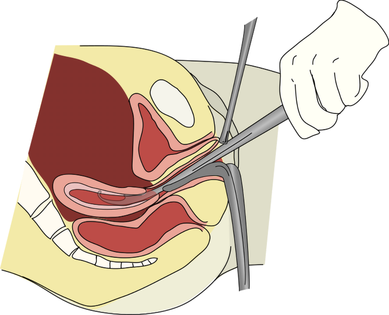 A gloved hand inserts a device through the vagina into the uterus, where the device scrapes the uterine wall.