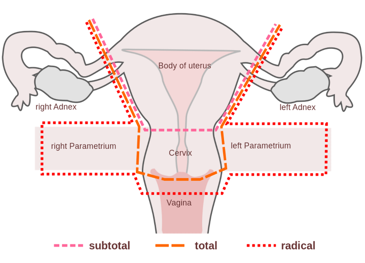 The uterus is shown with the vagina below. The uterine tubes (fallopian tubes) and ovaries are present. The left adnex (ovary and fallopian tube) and right adnex (ovary and fallopian tube) are labeled. The left and right parametrium are labeled. These are regions to the left and right of the uterus, including tissues in those areas. Lines describe different hysterectomies as follows: subtotal is the body of the uterus leaving the cervix below; total is the full uterus and cervix; and radical is the uterus, cervix, part of the vagina, and the left and right parametria.